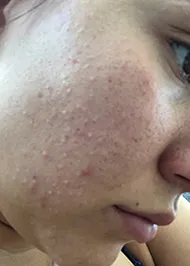 woman with acne before